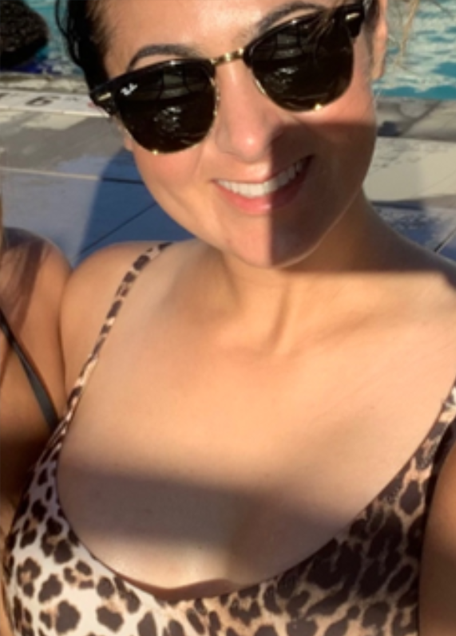 Breast Lift with Implants and Minimal Scar